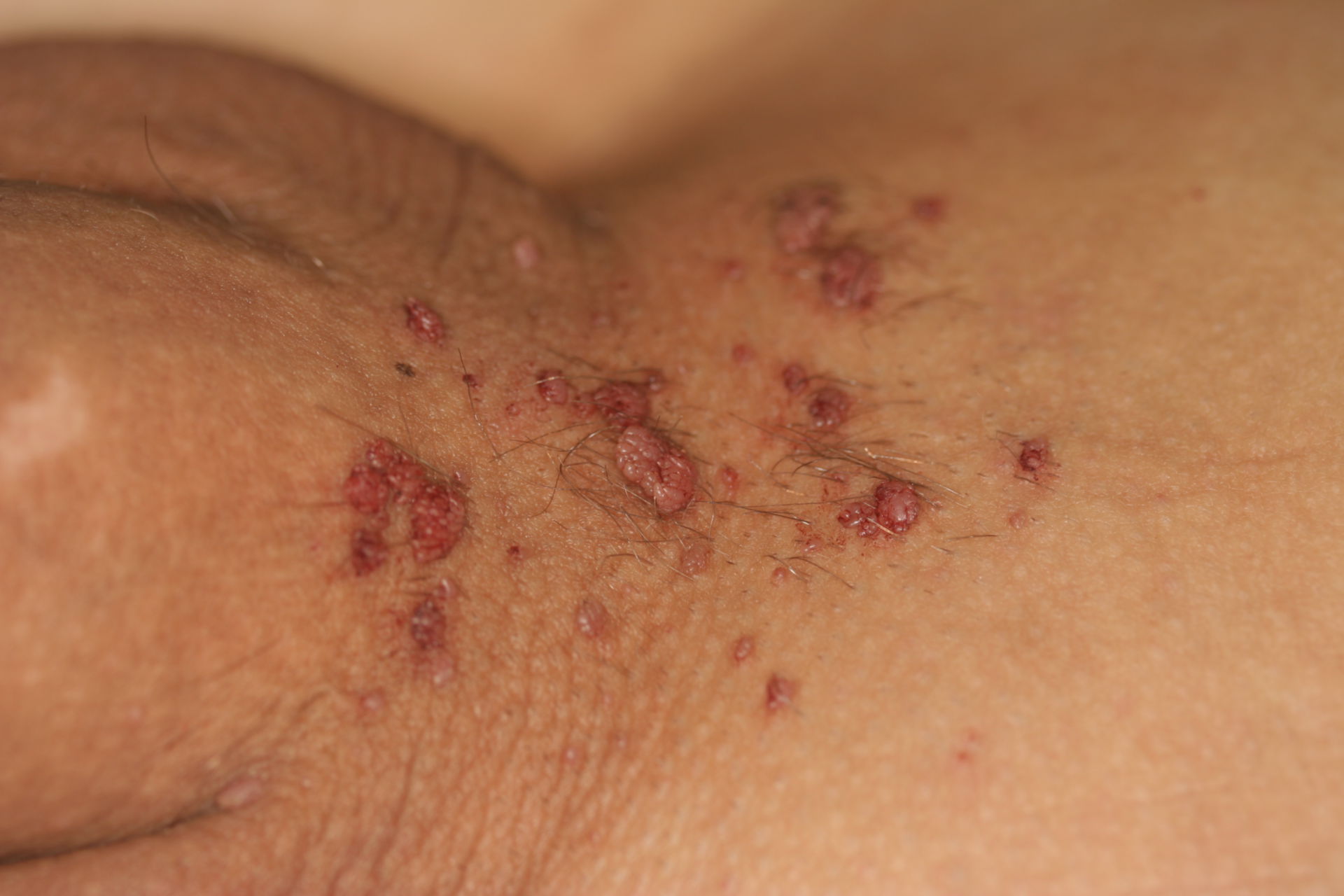 زگیل تناسلی چیست؟