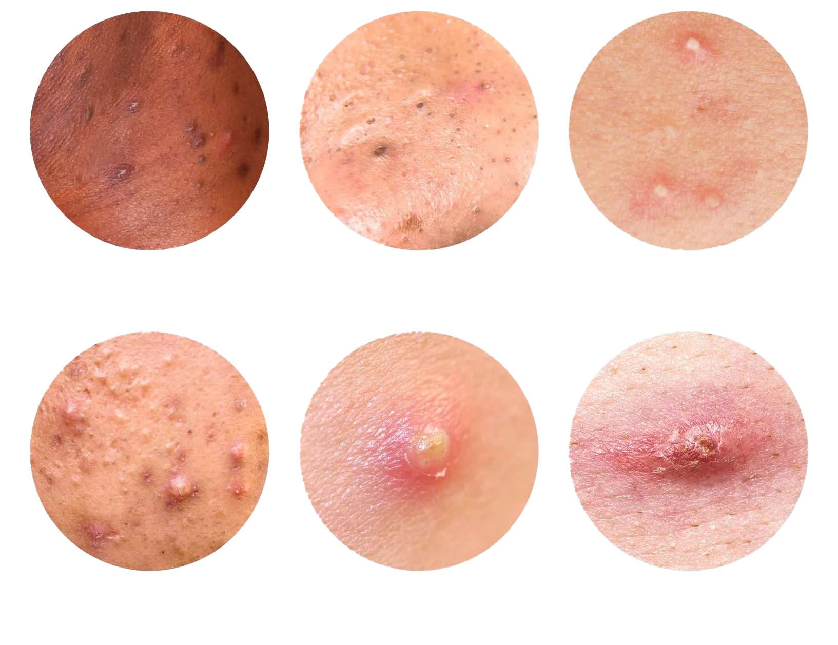 انواع زگیل تناسلی