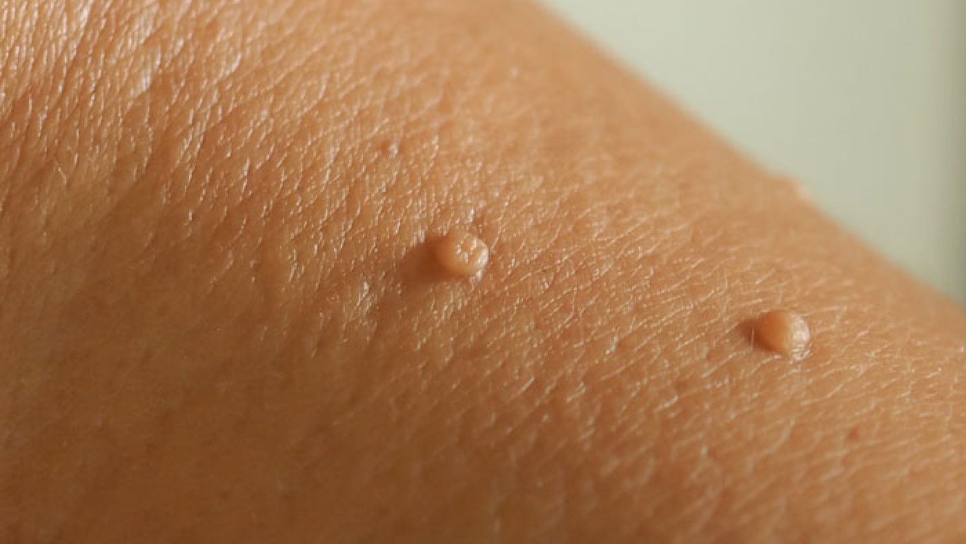 انواع زگیل تناسلی چیست؟؟؟؟